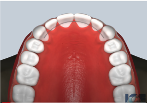 Bonded Retainer (Upper)