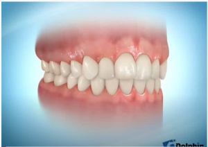 Invisible Aligners and Clear Aligners and Retainer (Orthodontics)