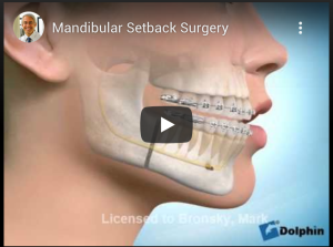 Mandibular Setback Surgery