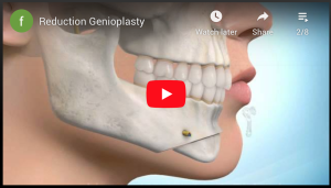 Reduction Genioplasty