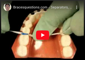 Bracesquestions.com - Separators, Spacers: How to Replace