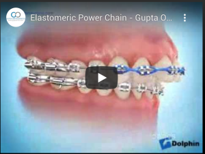 Elastomeric Power Chain - Gupta Orthodontics - Plano Invisalign & Damon Clear Braces