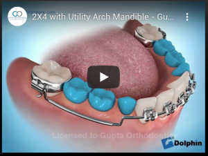 2X4 with Utility Arch Mandible - Gupta Orthodontics - Plano Invisalign & Damon Clear Braces