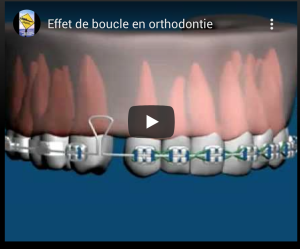 Effet de boucle en orthodontie