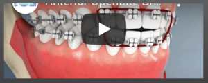 Anterior Openbite Braces