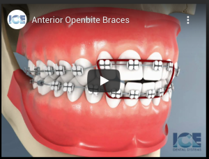Anterior Openbite Braces