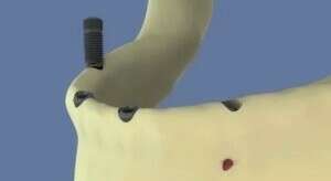 Mandibule : All on four