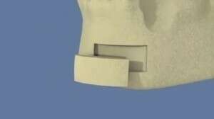 Bloc osseux d'origine symphysaire