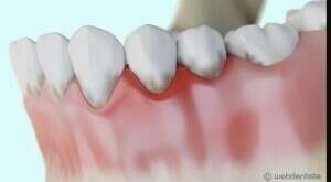 Traitement ultrasonique de la parodontite