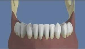 Mandibule : Bridge complet scellé sans fausse gencive