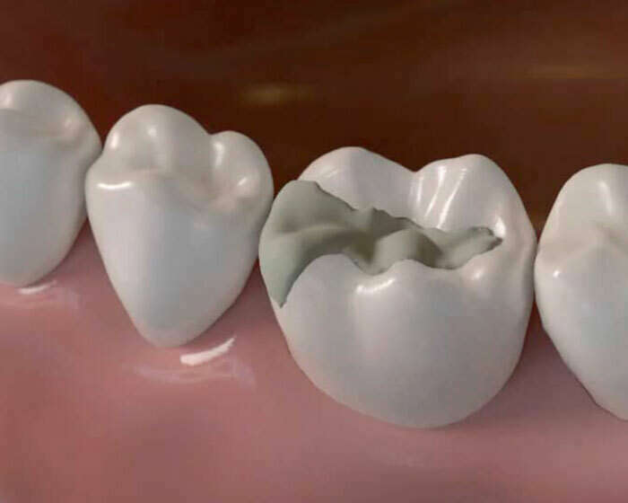 INLAY ET ONLAY, UNE TECHNIQUE CONSERVATRICE