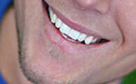 La ligne du sourire