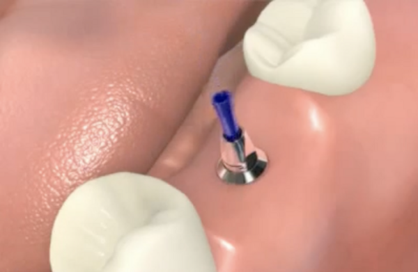 Couronne sur implant dentaire