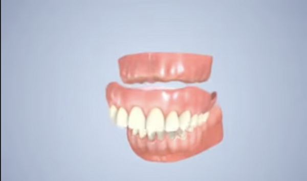 Prothèse dentaire complète amovible (dentier)