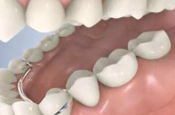 Prothèse dentaire partielle (partiel)