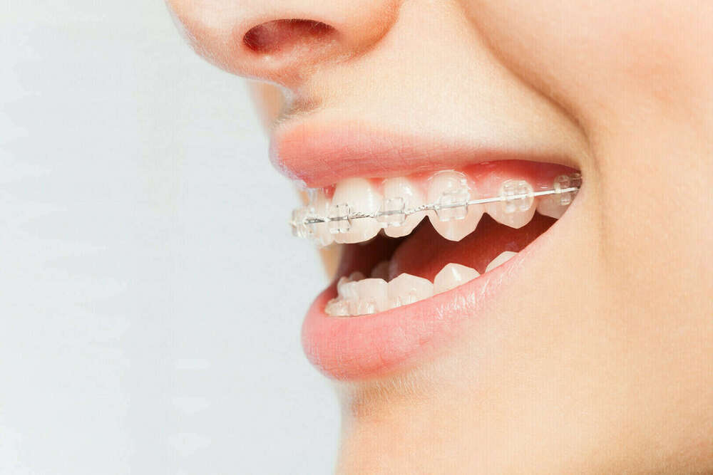 Les sept familles d'appareillages orthodontiques
