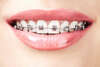 Orthodontie vestibulaire