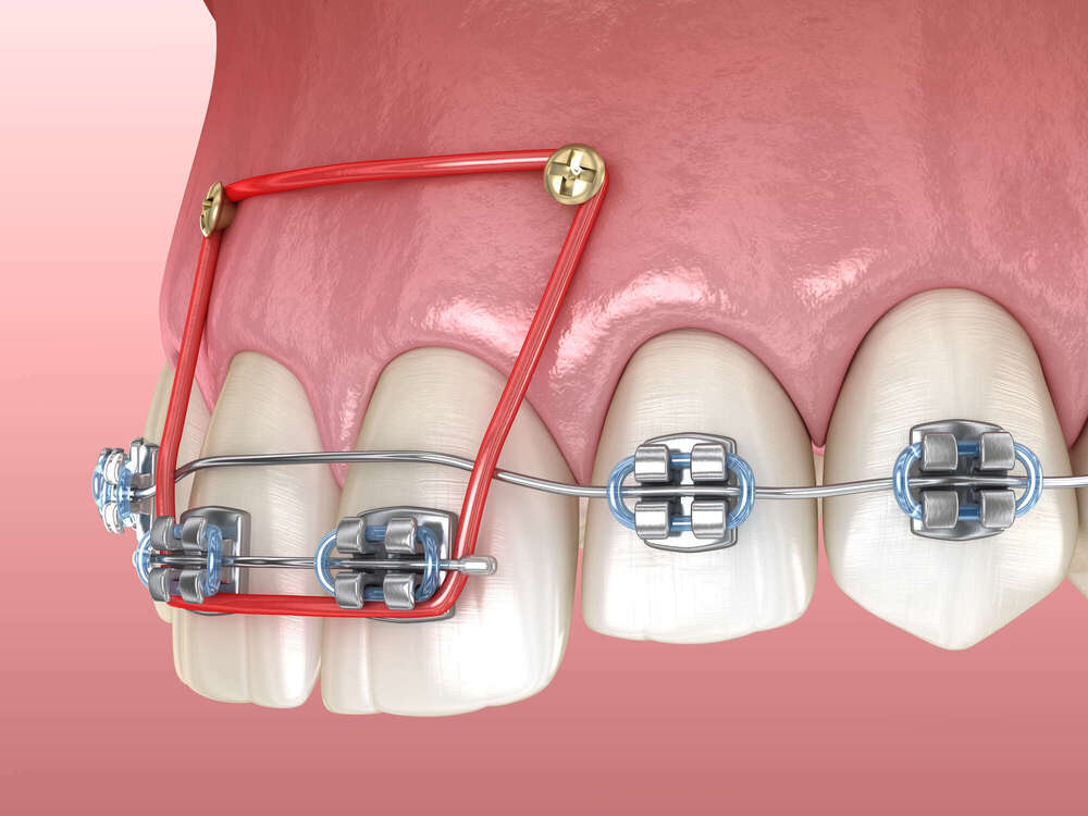 Les Mini-Implants d’Ancrage Orthodontique