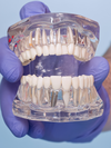 Prothèses sur implants au cabinet du Dr Thierry Neimann, Paris 8