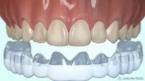 Blanchiment à la maison