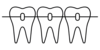 Orthodontie à Aix-en-Provence, illustration de dents avec appareil dentaire