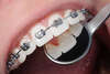 Orthodontie adulte à Aix-en-Provence intégrée à un traitement dentaire global