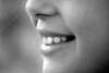 Les traitements orthodontiques de l'enfant à Aix-en-Provence
