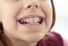 Interception orthodontique à Aix-en-Provence, enfant portant un appareil dentaire