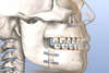 Modèle 3D chirurgie orthognathique montrant mâchoires et appareil