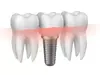 Dents d'implantation dentaire avec vis d'implant - cabinet du Dr Laurent CARPENTIER à Toulon