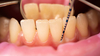 Dentiste effectuant restauration dentaire chez patiente blonde