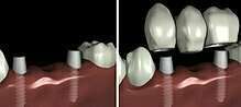 LA PROTHÈSE SUR IMPLANTS - DR VOIRY, DENTISTE À NANCY