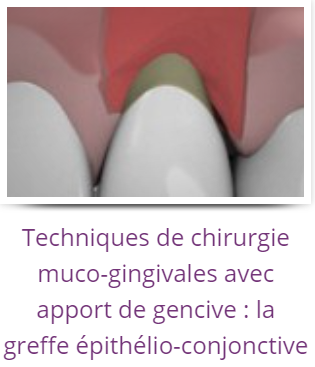FICHES CONSEILS - TECHNIQUES DE CHIRURGIE MUCO-GINGIVALES AVEC APPORT DE GENCIVE : LA GREFFE EPITHELIO-CONJONCTIVE