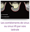comblement sinus