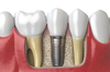 Les implants : question / réponses