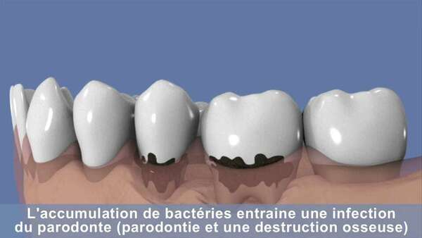 Le traitement non chirurgical de la parodontite