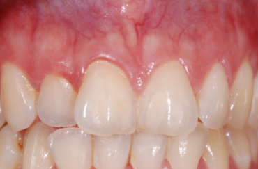 Cas clinique : Gingivite