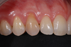 Contour de gencive de la canine et de la prémolaire avant greffe gingivale, Dr Alain Gracia, Bordeaux
