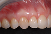 Contour de gencive de la canine et de la prémolaire après greffe gingivale