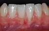 Greffe gingivale, cas n°1 : gencive avant traitement