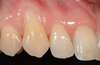 Greffe gingivale, cas n°2 : gencive avant traitement