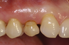 Cas 1 : remplacement d'une canine de lait par un implant et une couronne, Dr Alain Gracia, Bordeaux