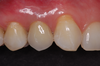 Cas 1 : canine de lait remplacée par un implant et une couronne, deuxième vue
