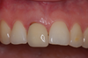 Cas 3 : incisive centrale droite avant pose d'un implant