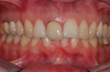 Cas 3 : incisive centrale droite avant implant, deuxième vue
