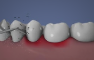 Traitement ultrasonique de la parodontite