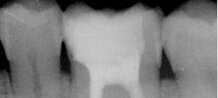 Cas clinique : Traitements endodontiques