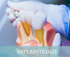 Implantologie