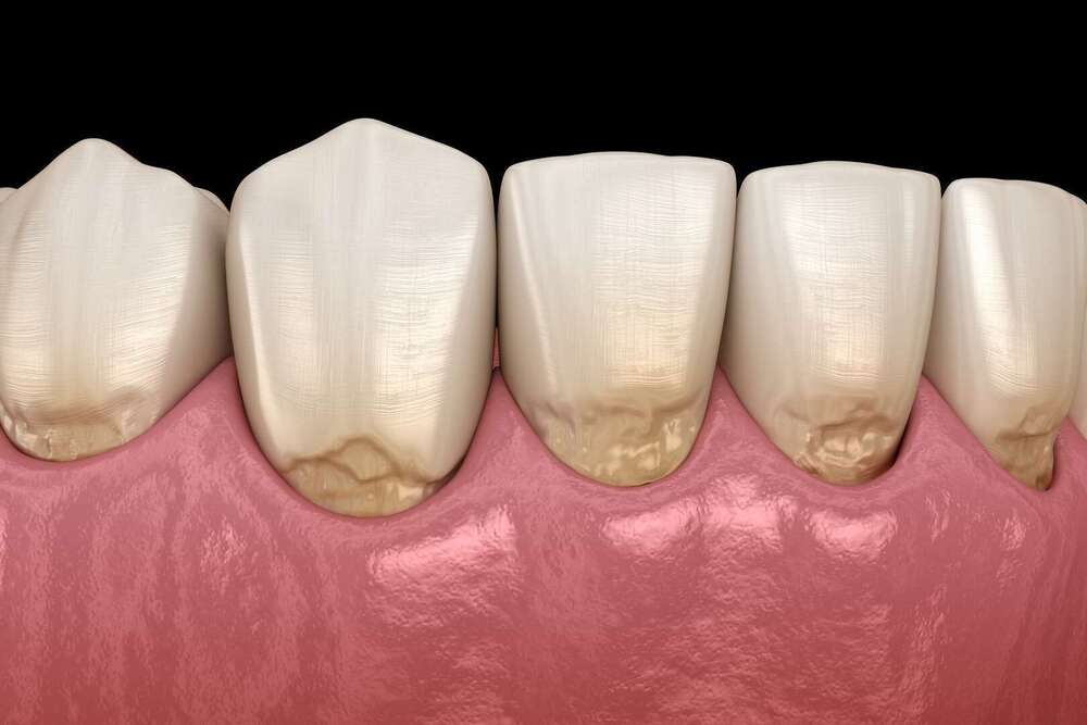 La mylolyse dentaire ou lésion cervicale d'usure