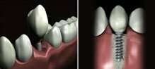 Cas clinique : Les implants dentaires